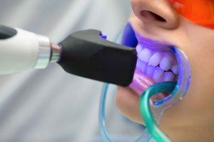 Teeth Whitening at Rye Family Dental Care